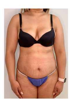 Mini Tummy Tuck, Patient 1
