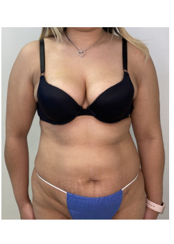 Mini Tummy Tuck, Patient 1