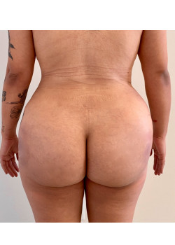 #BootyByLakshman (BBL), Patient 8