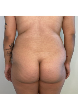 #BootyByLakshman (BBL), Patient 8