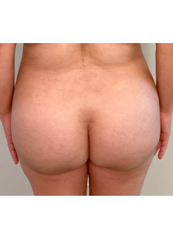 #BootyByLakshman (BBL), Patient 9