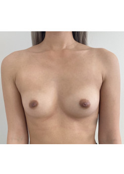 BREAST AUGMENTATION, PATIENT 80