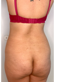 Mommy Makeover Deluxe (#BootyByLakshman/BBL followed by Full Tummy Tuck or Abdominoplasty) Patient 1