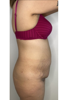 Mommy Makeover Deluxe (#BootyByLakshman/BBL followed by Full Tummy Tuck or Abdominoplasty) Patient 1 before photo. Individual results may vary.