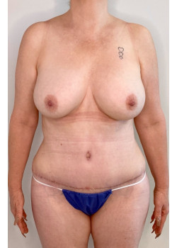 FULL ABDOMINOPLASTY, Patient 33