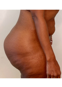 #BootyByLakshman(BBL), Patient 10