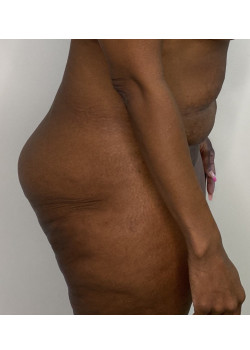 #BootyByLakshman(BBL), Patient 10