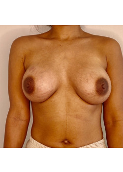 BREAST AUGMENTATION, PATIENT 81