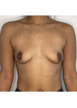 BREAST AUGMENTATION, PATIENT 81